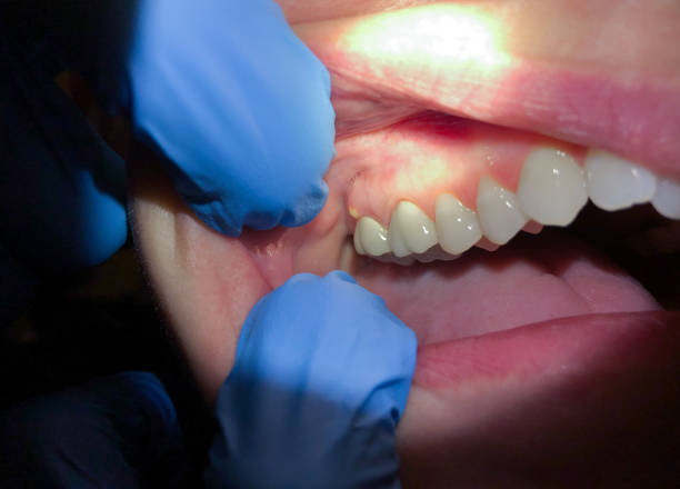 Best Emergency Dental Care for Abscessed Tooth in Quinebaug, CT